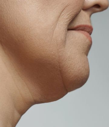  Belkyra Treatments for double chin in Montreal Before pictures