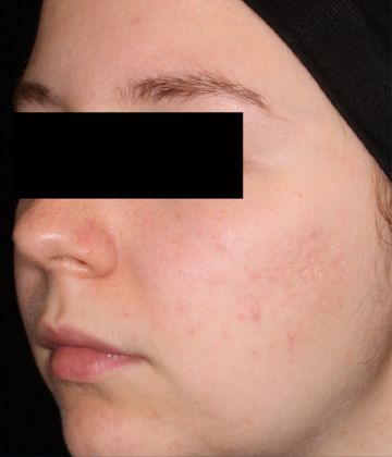 Après le traitement d’élimination de l’acné au laser, Montreal