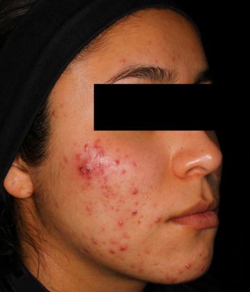 Avant d’élimination de l’acné au laser à Montréal