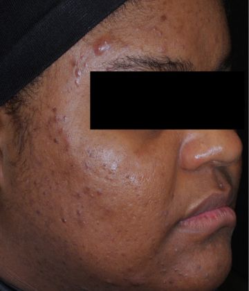 Après le traitement d’élimination de l’acné au laser AviClear à la Clinique Corps Idéal, Montréal