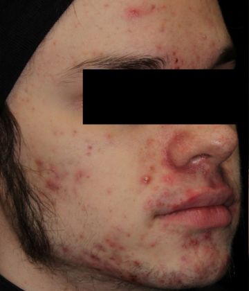 Avant le traitement d’élimination de l’acné au laser à Montréal