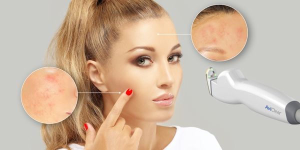 AviCLear laser acne removal in Montreal