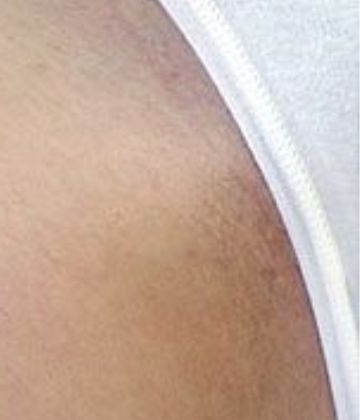 After bikini laser hair removal treatment in Montreal