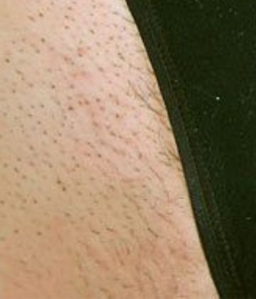 Before bikini laser hair removal treatment in Montreal