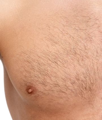 Chest before picture laser hair removal treatment ideal body clinic in Montreal