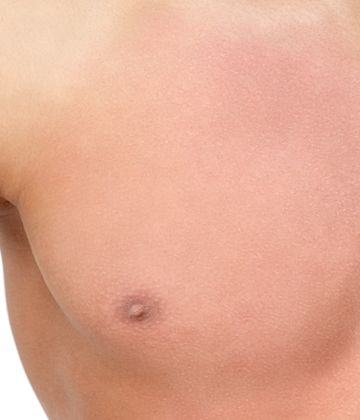 Chest after picture laser hair removal treatment ideal body clinic in Montreal