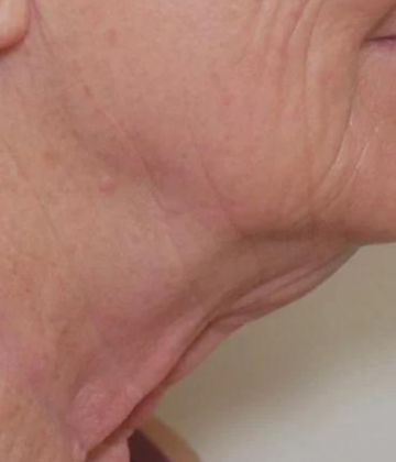 Traitement Sofwave de resserrement de la peau après