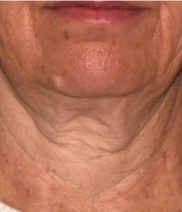 Photo du traitement Sofwave du visage avant à Montréal