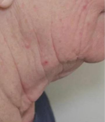 Traitement Sofwave de resserrement de la peau avant