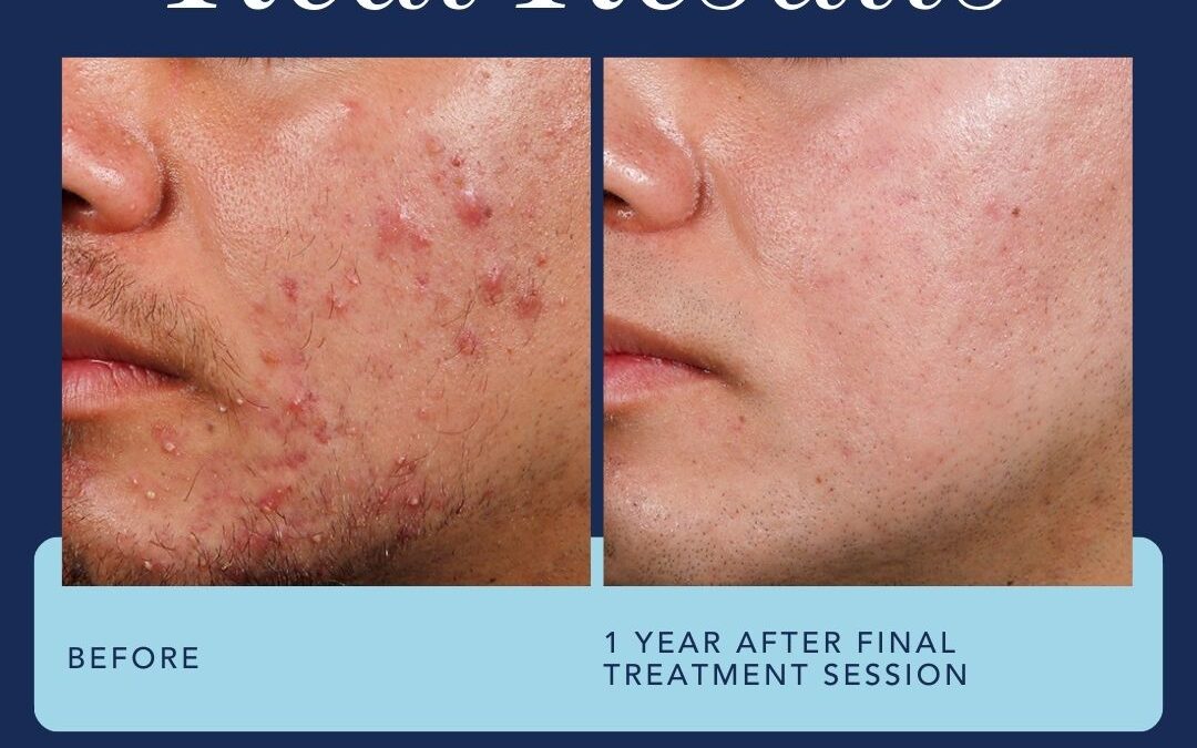 Clear Skin Ahead: Exploring Effective Acne Treatments/