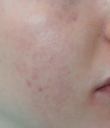 After Secret Pro by Cutera for acne - Montreal