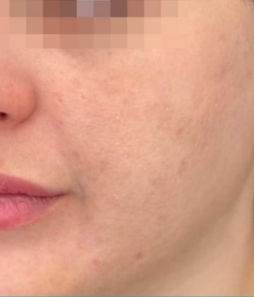 After Secret Pro by Cutera for acne and acne scars - Montreal