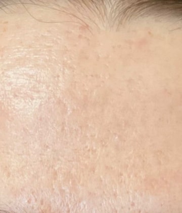 After Secret Pro by Cutera for forehead skin - Montreal