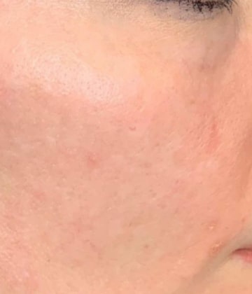 After Secret Pro by Cutera for skin damage - Montreal