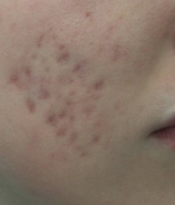 Before Secret Pro by Cutera for acne - Montreal