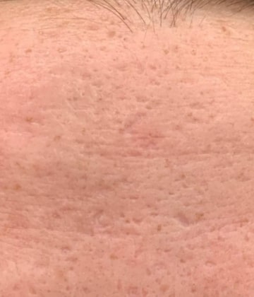 Before Secret Pro by Cutera for forehead skin - Montreal 