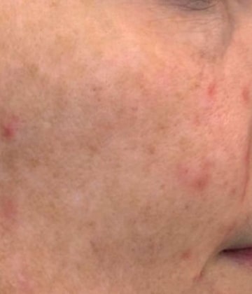 Before Secret Pro by Cutera for skin damage - Montreal