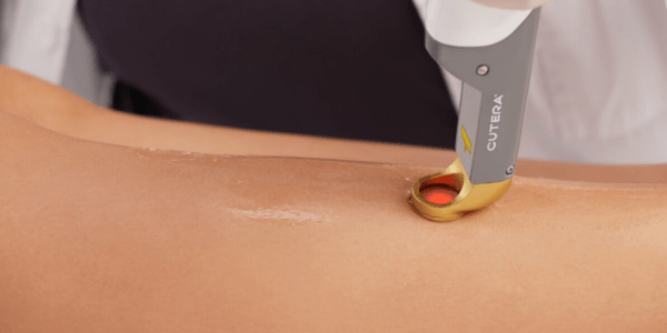 Get laser hair removal treatments, treat pigmented and vascular lesions with Laser Excel HR in Montreal