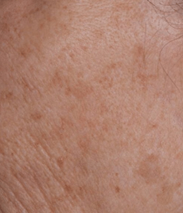 Skin spots removal after Excel HR treatment in Montreal