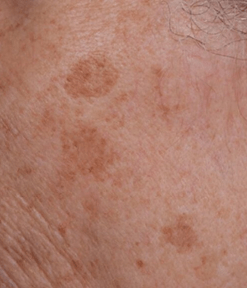 Skin spots removal before Excel HR treatment in Montreal