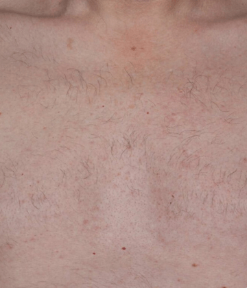 Chest laser hair removal after Excel HR treatment in Montreal