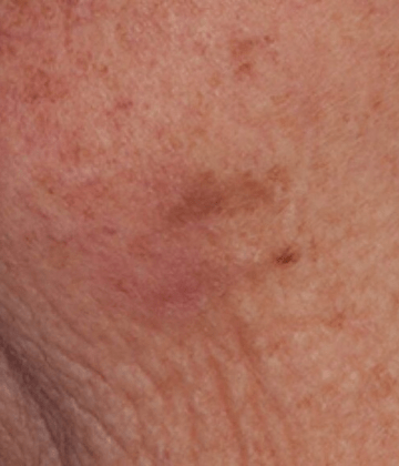 Facial pigmented lessions removal after Excel HR treatment in Montreal