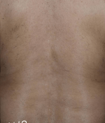 Back laser hair removal after Excel HR treatment in Montreal
