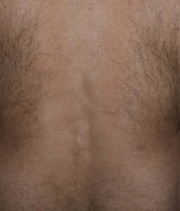 Back laser hair removal before Excel HR treatment in Montreal