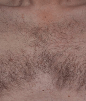 Chest laser hair removal before Excel HR treatment in Montreal