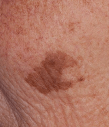 Facial pigmented lessions removal after Excel HR treatment in Montreal