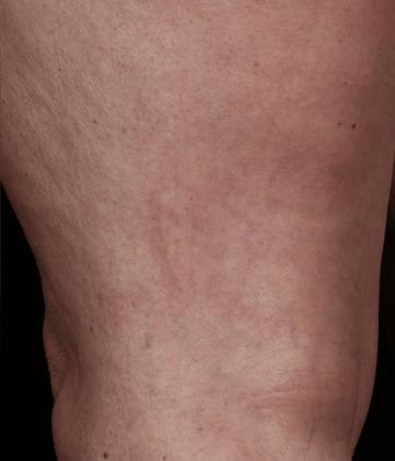 Spider vains removal after Excel HR treatment in Montreal