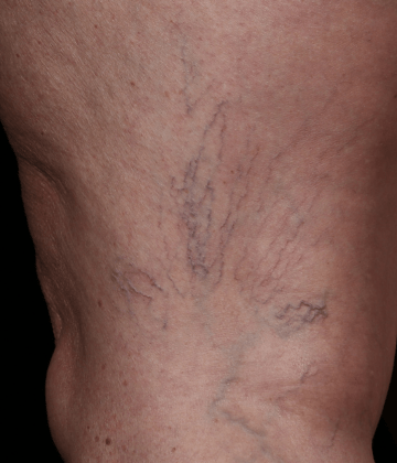 Spider vains removal before Excel HR treatment in Montreal