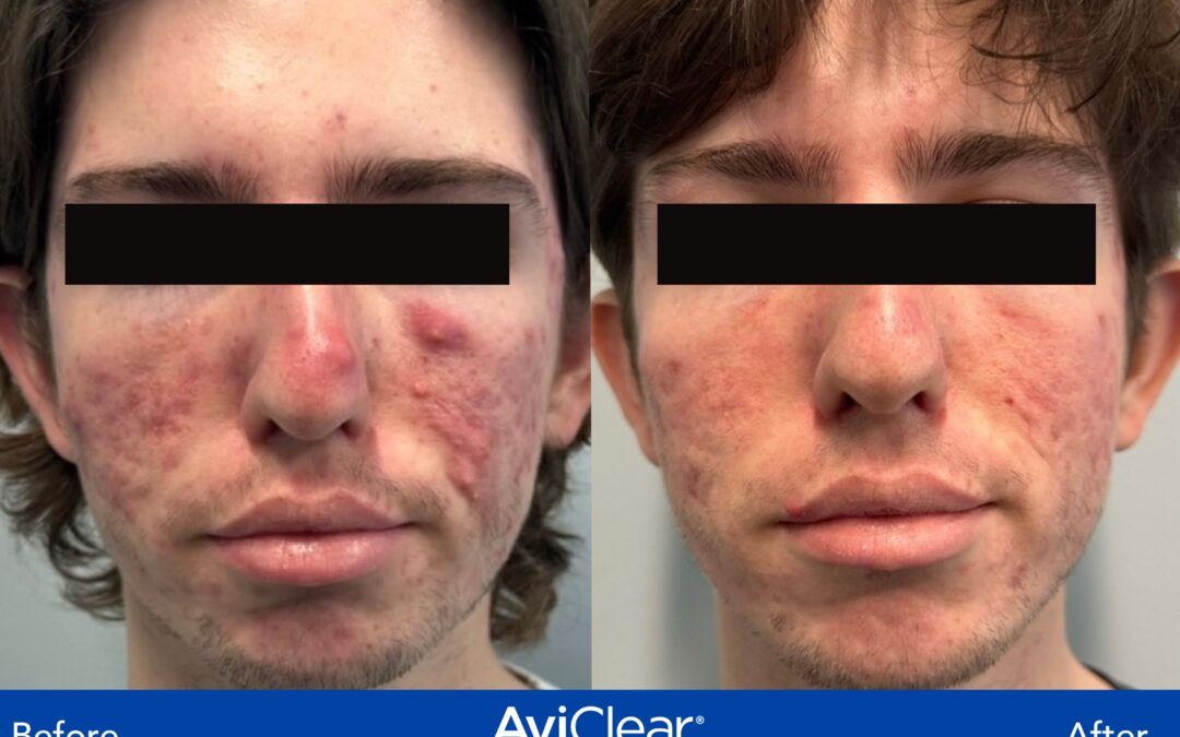 Acne and Acne Scar Treatments Offered at Ideal Body Clinic Montreal