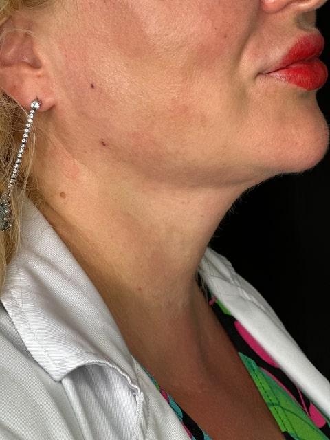 After Female Neck Lines Dermal Fillers procedure at our Montreal aesthetic clinic