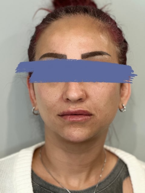 After Female Lip Fillers procedure at our Montreal aesthetic clinic