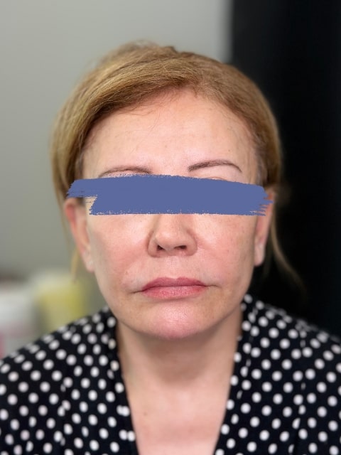After Female Radiesse Jawline Fillers procedure at our Montreal aesthetic clinic