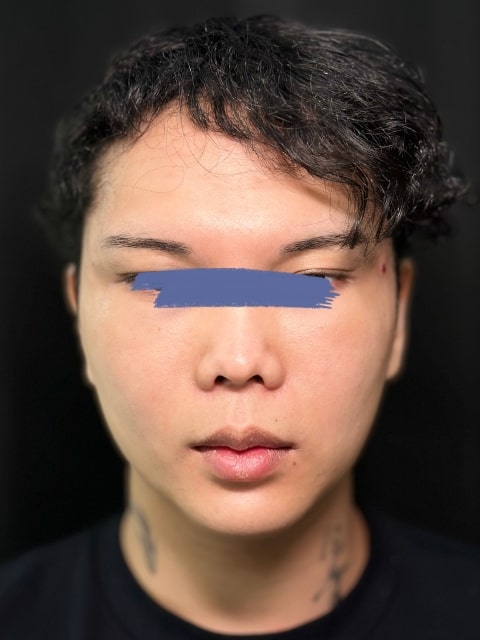 After Male Cat Eyes PDO thread lift procedure at our Montreal aesthetic clinic