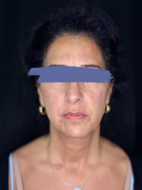 After Female Cheeks and Marionette Lines Dermal Fillers procedure at our Montreal aesthetic clinic