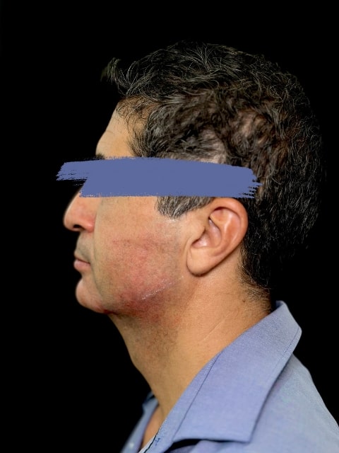 After Male Jawline Fillers procedure at our Montreal aesthetic clinic