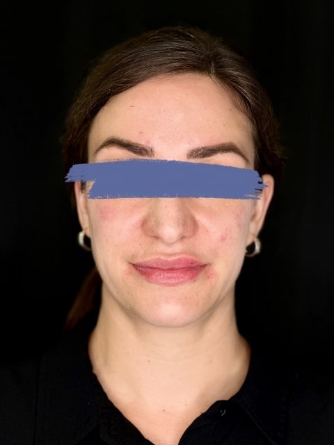 After Female Cheeks and Lips Dermal Fillers procedure at our Montreal aesthetic clinic