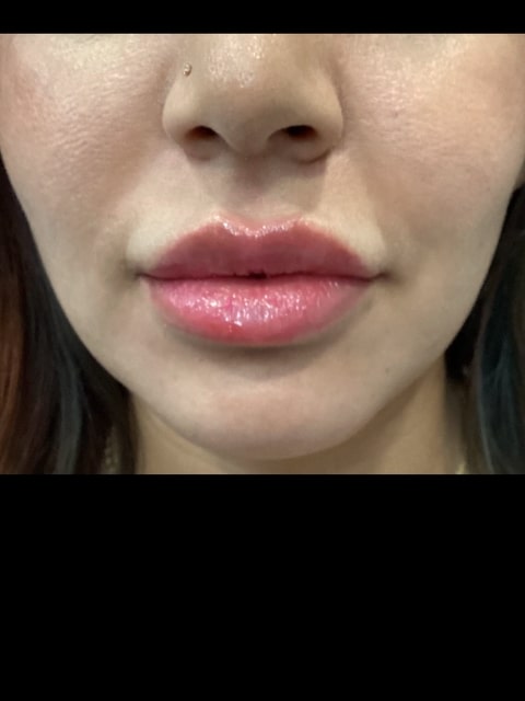 After Female Lip Fillers procedure at our Montreal aesthetic clinic
