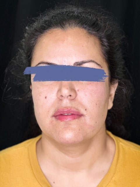 After Female Lip Fillers procedure at our Montreal aesthetic clinic