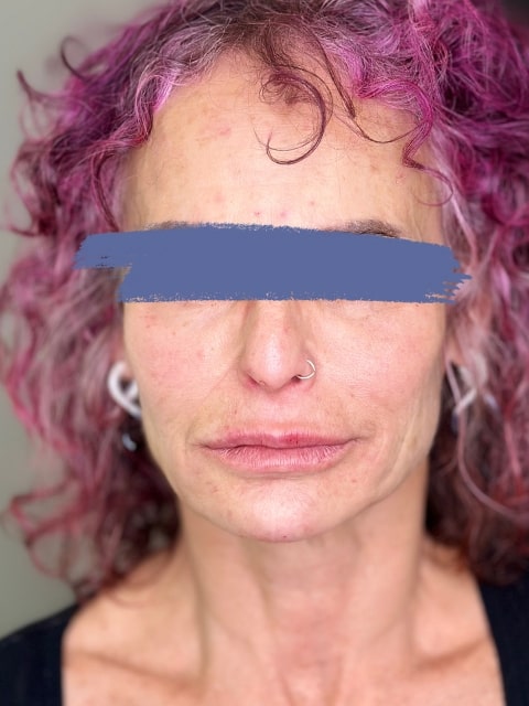 After Female Lip Fillers procedure at our Montreal aesthetic clinic