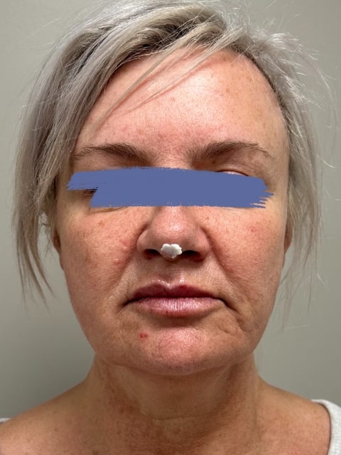 After Female PDO thread nose lift procedure at our Montreal aesthetic clinic