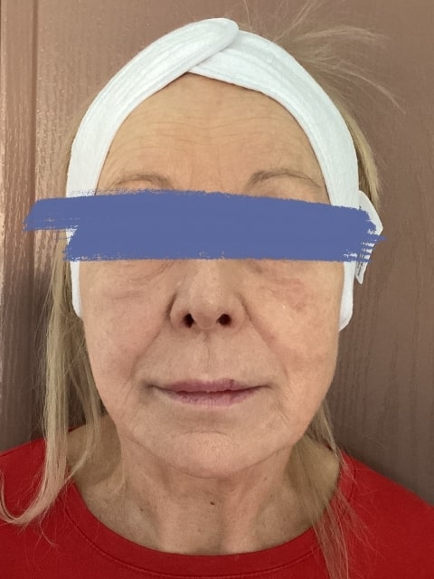 After Female Dermal Fillers procedure at our Montreal aesthetic clinic