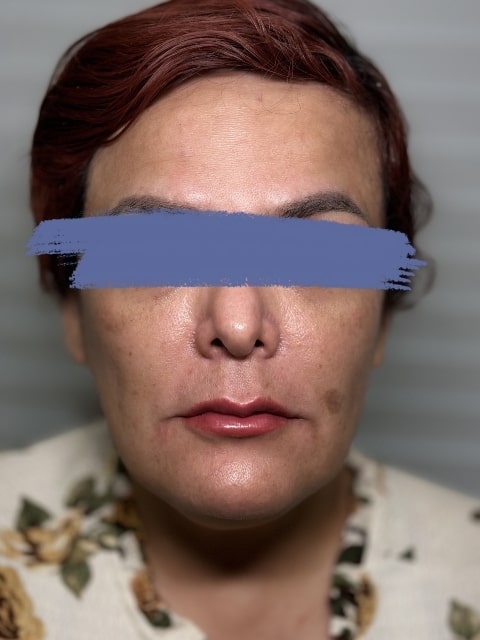 After Male Lip Fillers procedure at our Montreal aesthetic clinic