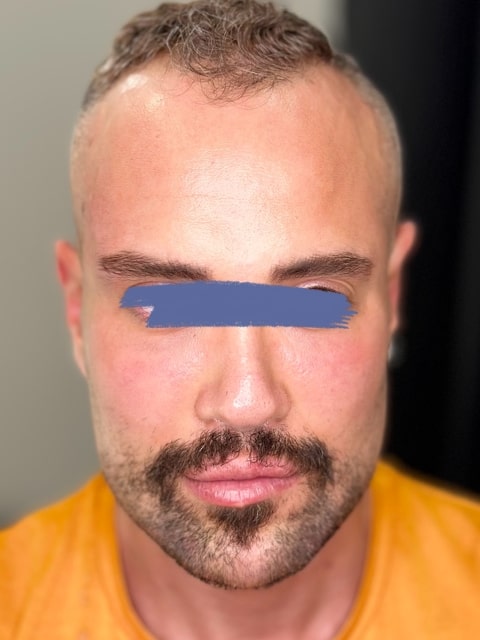 After Male Cat Eyes PDO thread lift procedure at our Montreal aesthetic clinic