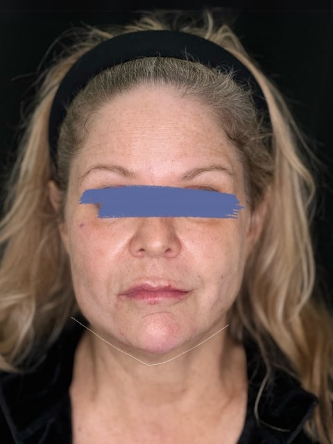 After Female Jawline PDO thread lift procedure at our Montreal, Quebec aesthetic clinic (frontal view)