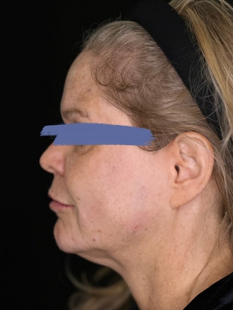 After Female Jawline PDO thread lift procedure at our Montreal, Quebec aesthetic clinic (side view)