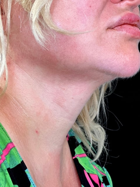 Before Female Neck Lines Dermal Fillers procedure at our Montreal aesthetic clinic